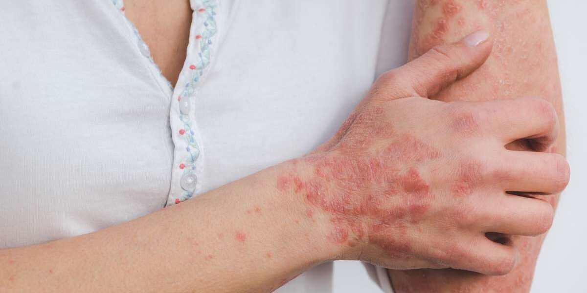 Pessoas realizando cuidados com a pele em um ambiente relaxante para prevenir crises de psoríase